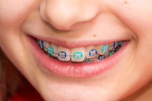 Ortodoncia para Niños en Fuenlabrada Madrid España