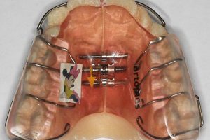 Ortodoncia para Niños en Fuente el Saz de Jarama | Tratamientos Dentales Madrid
