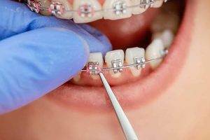 Ortodoncia para Niños en Fuentidueña de Tajo Madrid España