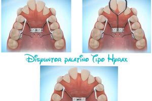 Ortodoncia para Niños en Garganta de los Montes, Madrid España